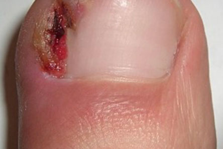 Ingrowing toenail