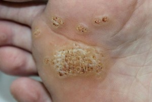 Podiatry (skin & nail): Verrucae