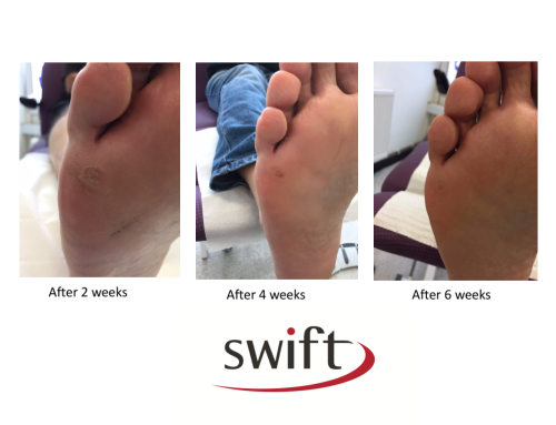 Swift Treatment for Stubborn Verruca’s – Before and After